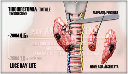tiroidectomia totale
